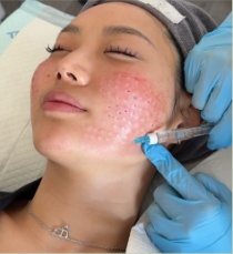 Client receiving an injectable skin treatment at Kozie Skin Clinic